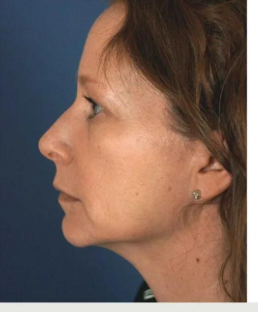 Before Juvederm cheek filler treatment — Independence area patient at KC Med Spa Group